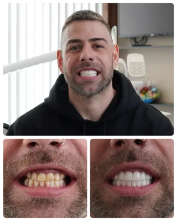 Hollywood Smile transformation — Timothy